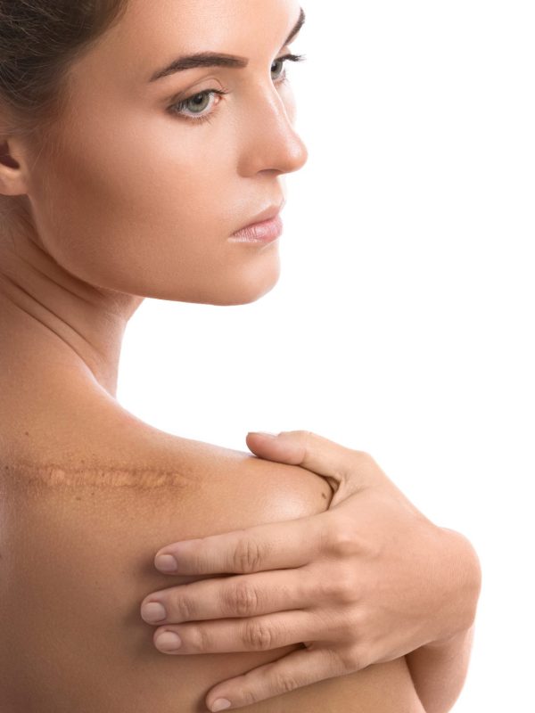 Woman with a scar on her shoulder over white background
